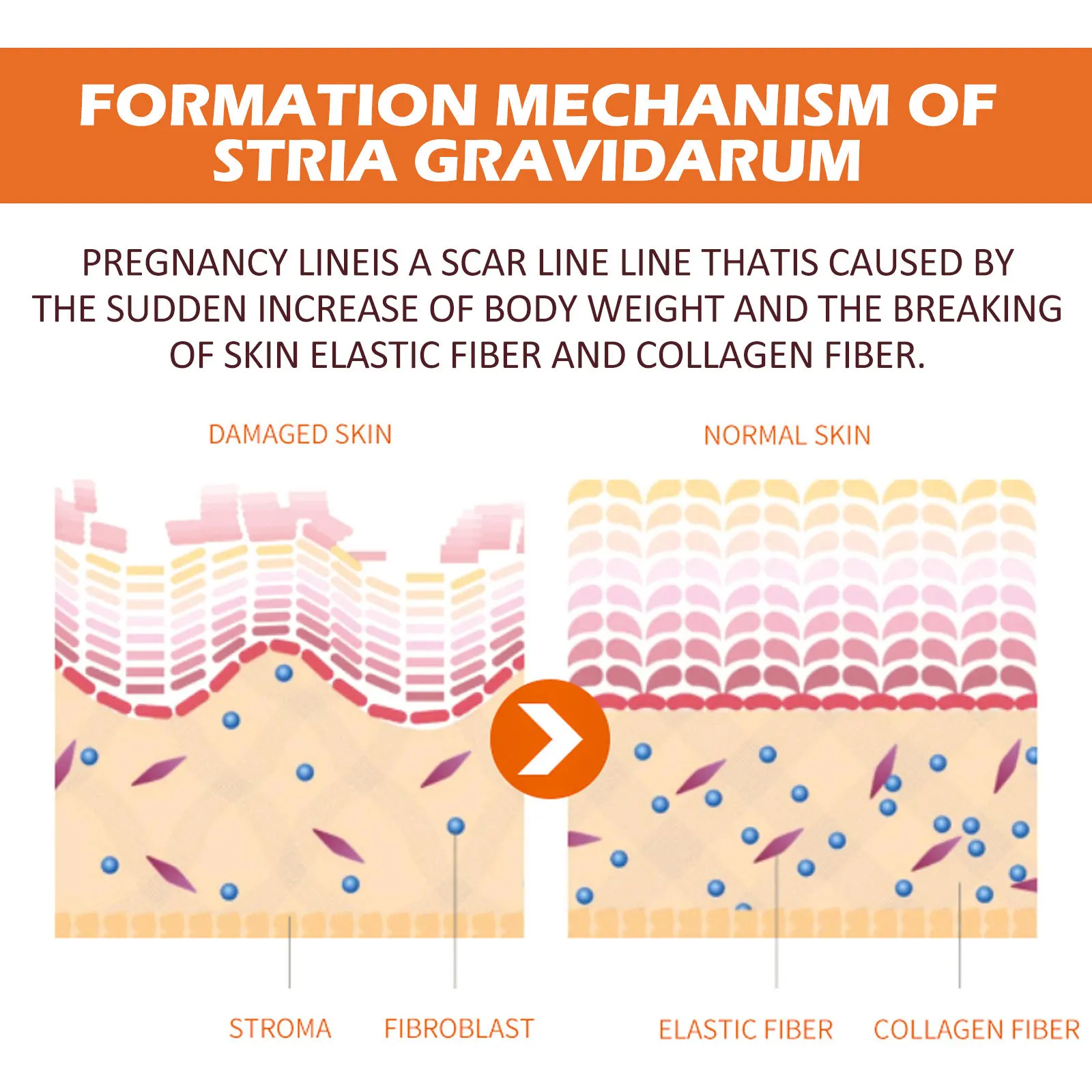 Pregnancy Stretch Mark Fading Scar Repair Smooth Firming Skin Neuropeptide Protein Repair Massage Cream