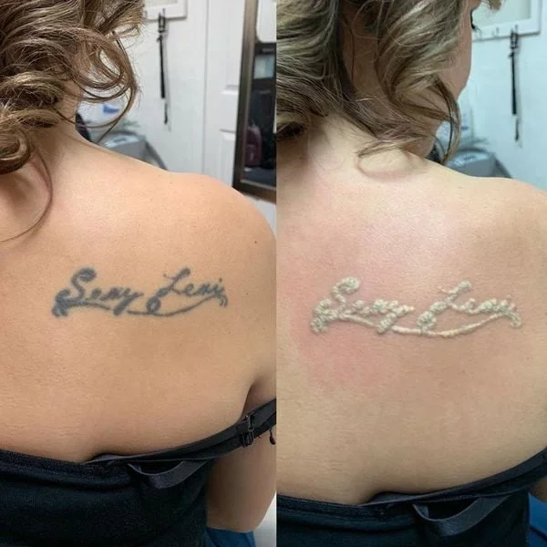 Sincoheren top popular professional tattoo removal pigmentation removal machine q switched nd yag laser device with CE approved