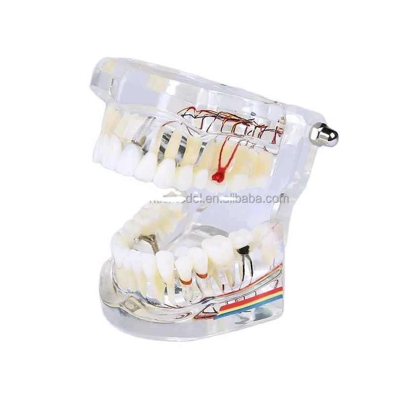 1:1 модель имплантации натурального размера с мостом шпоном карией узором инкрустацией демонстрационная чистого цвета