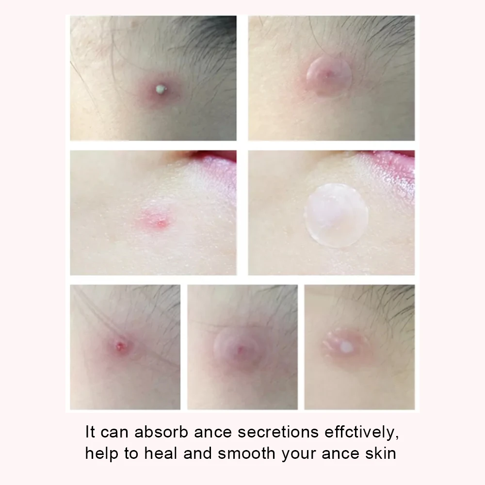 In stock 144 Pcs Acne Pimple Master Patch Waterproof Pimple Patch Hydrocolloid Acne Patch