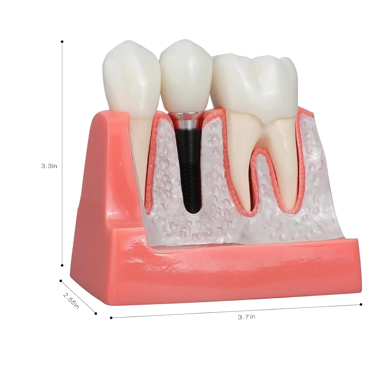 Dental Implant Model with Removable Analysis Crown Bridge Demonstration Teeth 4 Times for Medical Science Education Studying