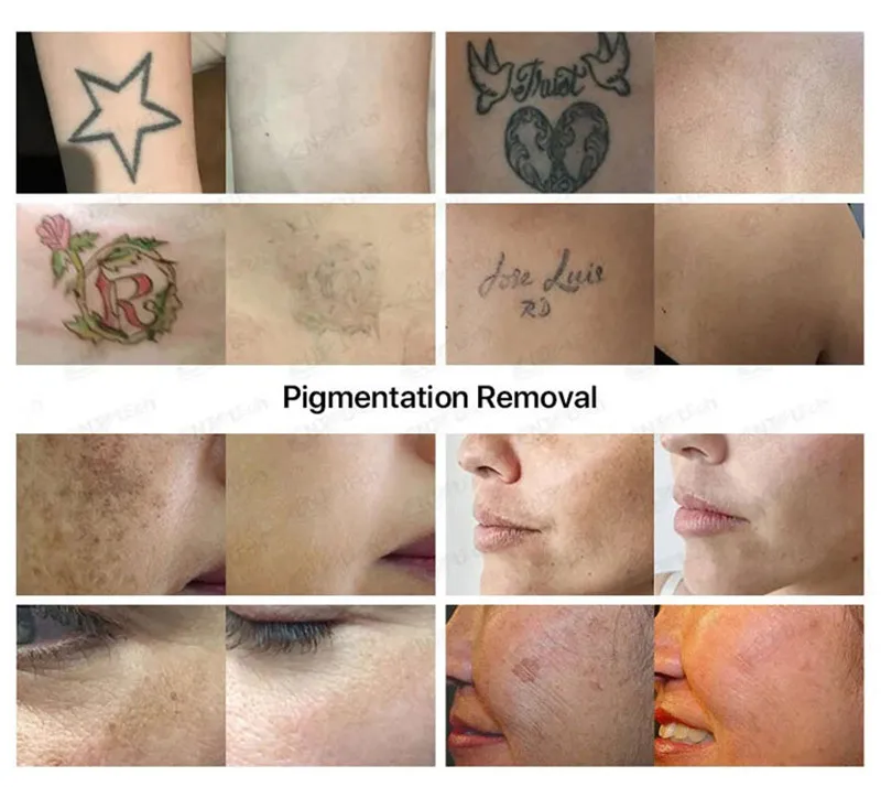 Factory Price Effective Professional IPL OPT E-light Dpl Machine Skin Rejuvenation Pigment Freckle Laser Hair Removal