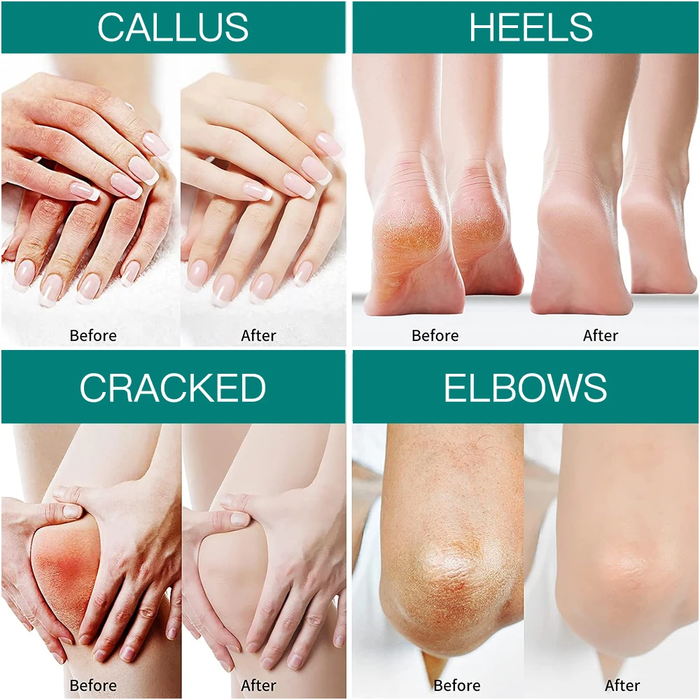 Крем для ухода за ногами увлажнение отбеливание удаление покраснений и омертвевшей кожи