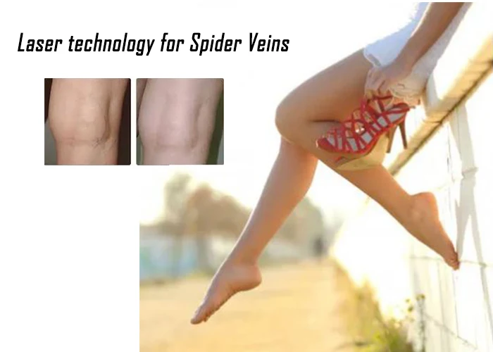 Berylas 1470nm diode laser for spider vein removal/vascular surgery EVLT device