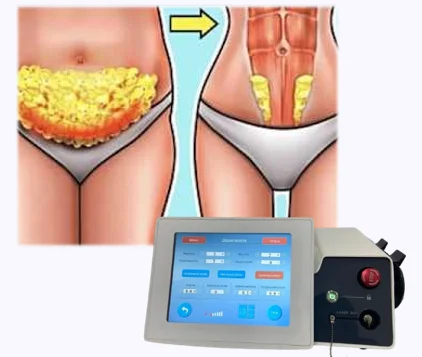 U.S. Approved 1470nm Endolaser Machine Dual Wavelengths 980nm Lipolysis Cannulas Liposuction Tower Lipolaser Fat Filter