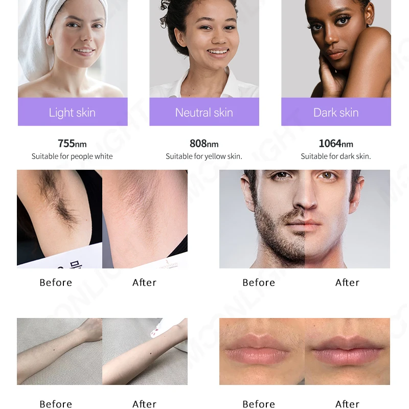 2023 2000w laser 755nm 808nm 940nm 1064nm 4 wavelength diode laser hair removal machine use for beauty salon equipment