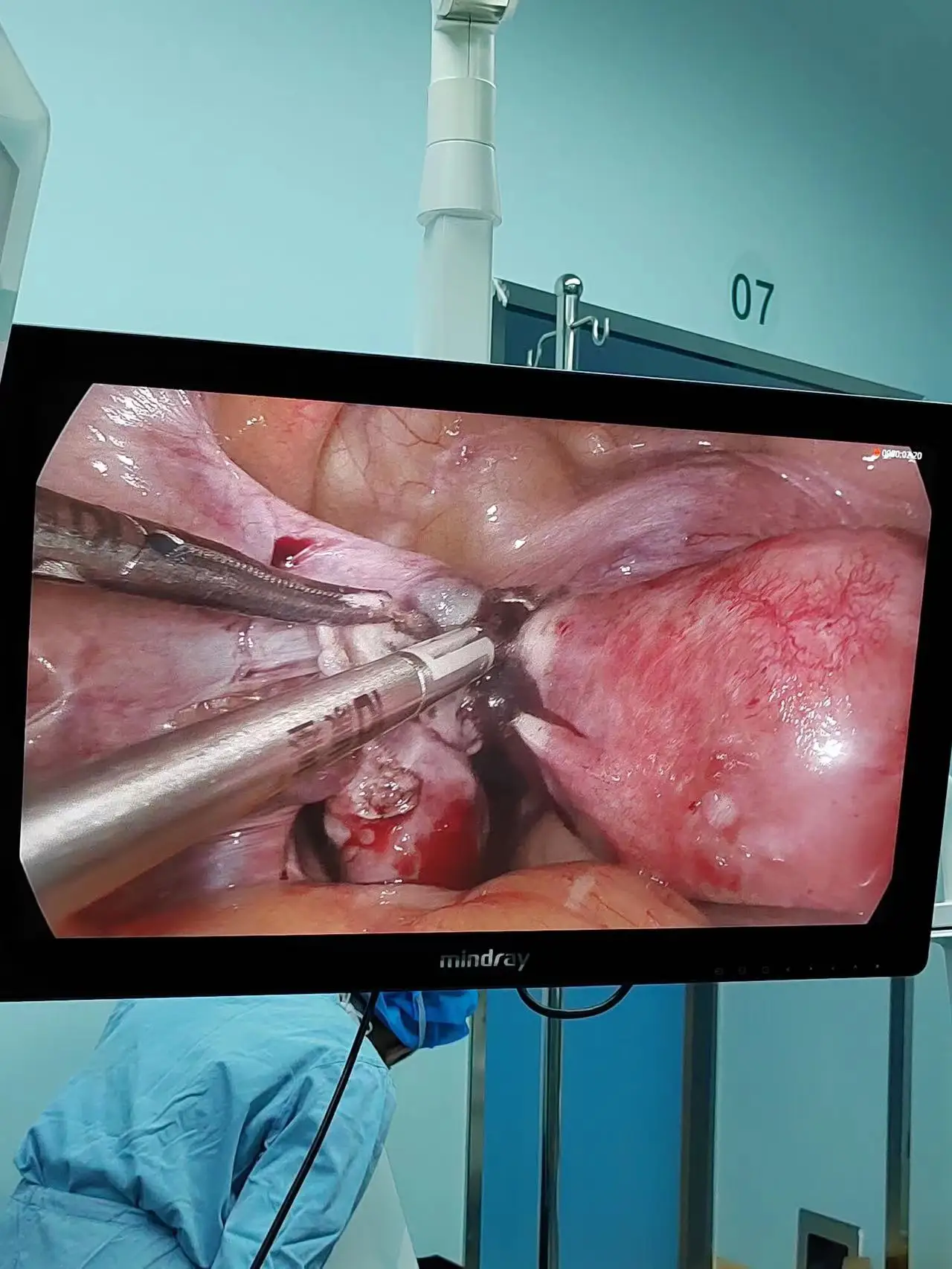 Hospital multi function integrated full HD endoscope camera for laparoscopy endoscope system