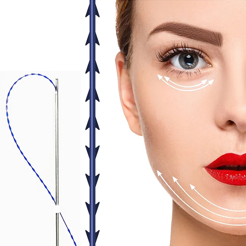 Factory Pdo Facial Lifting Thread fish bone W needle 18G 100MM Neogenesis Rejuvenation Pdo thread for face