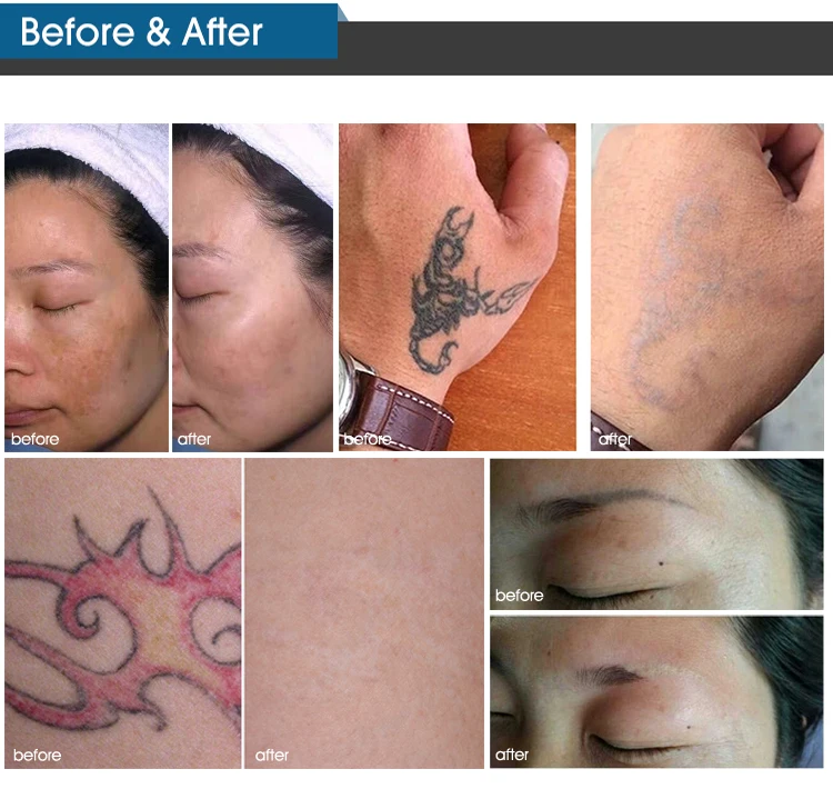 ND-YAG Pico laser tattoo removal machine for tattoo removal ink, pigmention and birth mark removal