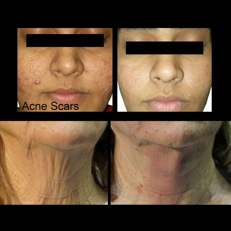 Anti-aging Barbed Suture CE COG 4D L Cannula barbed suture wire fact lift hilos tensores PDO Thread