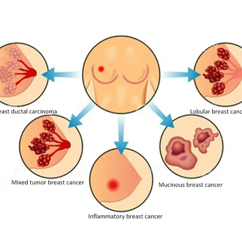 Breast Patch Without Adhesive Breast Cancer Iron Patches Sante Health Care Breast Pain Help Relieve Patch