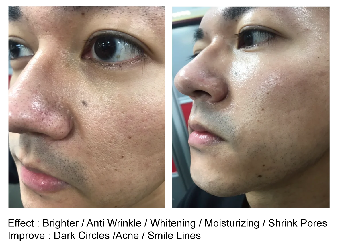 maskne pore shrinking anti wrinkle best face mask skin care