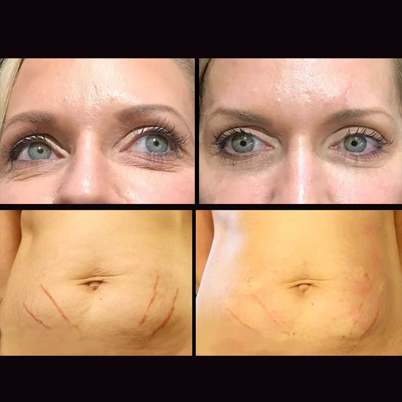 silhouette soft blunt needle cannula aptos thread lift cone pdo face lift 18g hilos de pdo thread cog