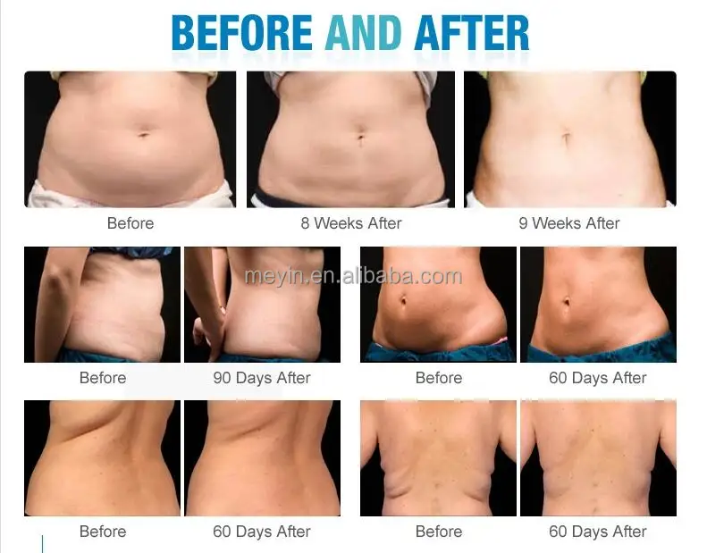 Hot Selling Products 2021 Factory Price 360 Criolipolisis Machine Cryolipolysis/ fat freezing machine parts