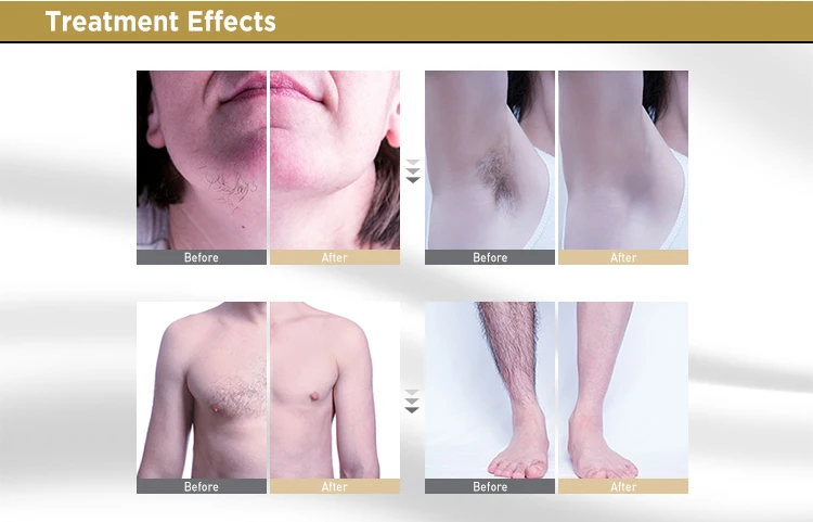 ADSS hot selling laser diode 755 808 940 1064 Permanent painless ice 808nm diode laser hair removal machine