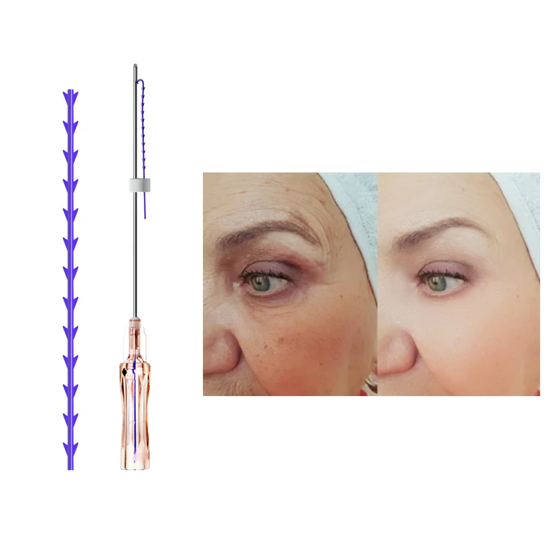 Factory Pdo Facial Lifting Thread fish bone W needle 18G 100MM Neogenesis Rejuvenation Pdo thread for face