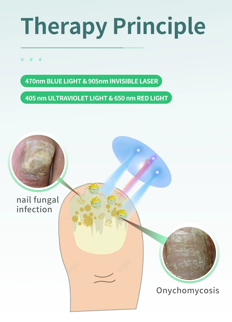 nail fungus laser toenail treatment machine foot and finger onychomycosi physiotherapy device personal health care products
