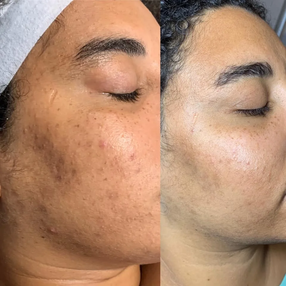 IPL OPT Elight hair removal skin tightening machine Photorejuvenation IPL beauty machine CE approved