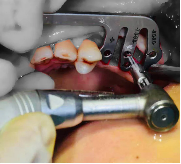 
Set of 6 Dental Gauge Implant Surgical Drilling Guide Locator Parallel Depth Pin dental implant RAF universal dental implant kit 