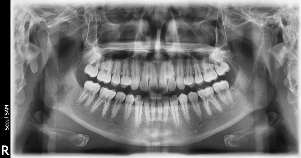 USED/REFURBISHED DIGITAL PANORAMIC DENTAL X-RAY SYSTEM w/wo CEPHALO UNIT
