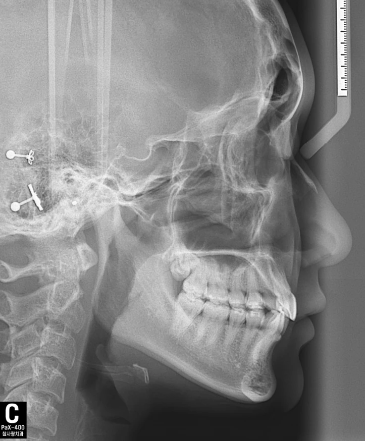 С использованием цифрового панорамная зубоврачебная X-RAY системы VATECH w/wo cephalo
