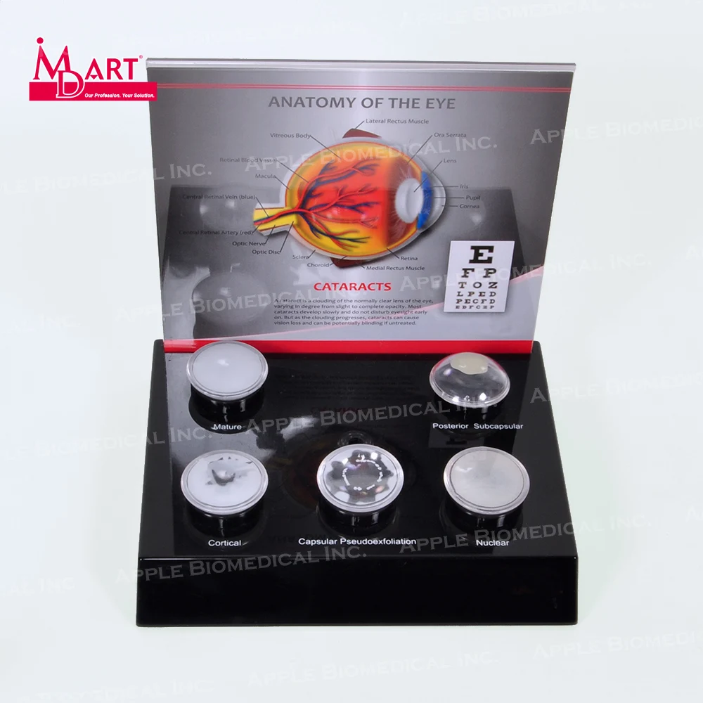 
Human eye model with replaceable disease cataract lens in medical science 