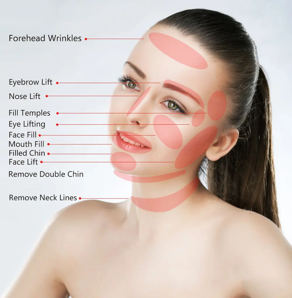 Professional Supplier Pdo Cog R Cannula Pdo Cog Lifting Thread Screw