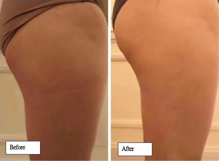 Body slimming and fat reduction machine 2 in 1, three years warranty and factory price free training provided