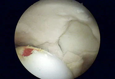 Sawbones 1703-696 Express Arthroscopy Hip