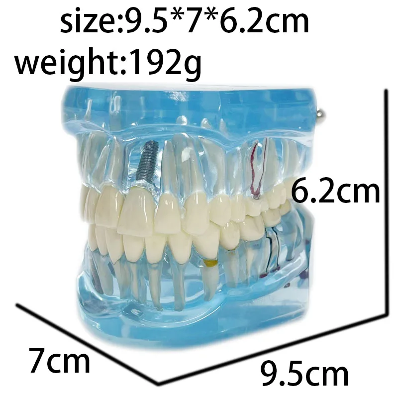 Производство изготовление на заказ прозрачная для взрослых патологическая Стоматологическая модель обучения зубам демонстрация зубных имплантов