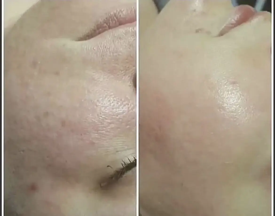 
Otesaly Skin Rejuvenation Device Anti Wrinkle Non Cross-linked HA 