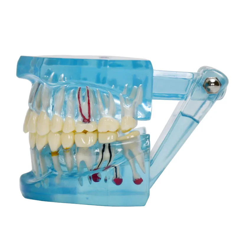 Производство изготовление на заказ прозрачная для взрослых патологическая Стоматологическая модель обучения зубам демонстрация зубных имплантов