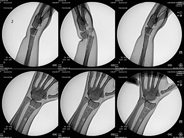 Sawbones 1530 Colles тренировочная техника снижения и литья