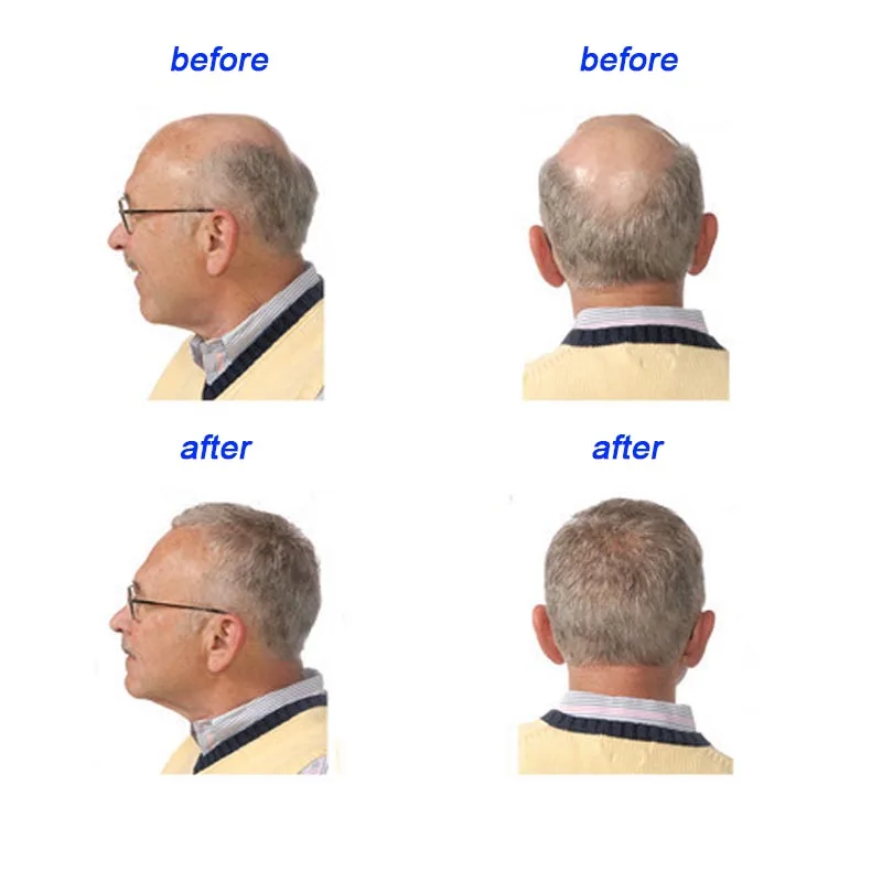 Original manufacturer solve hair loss Yuda hair loss treatment