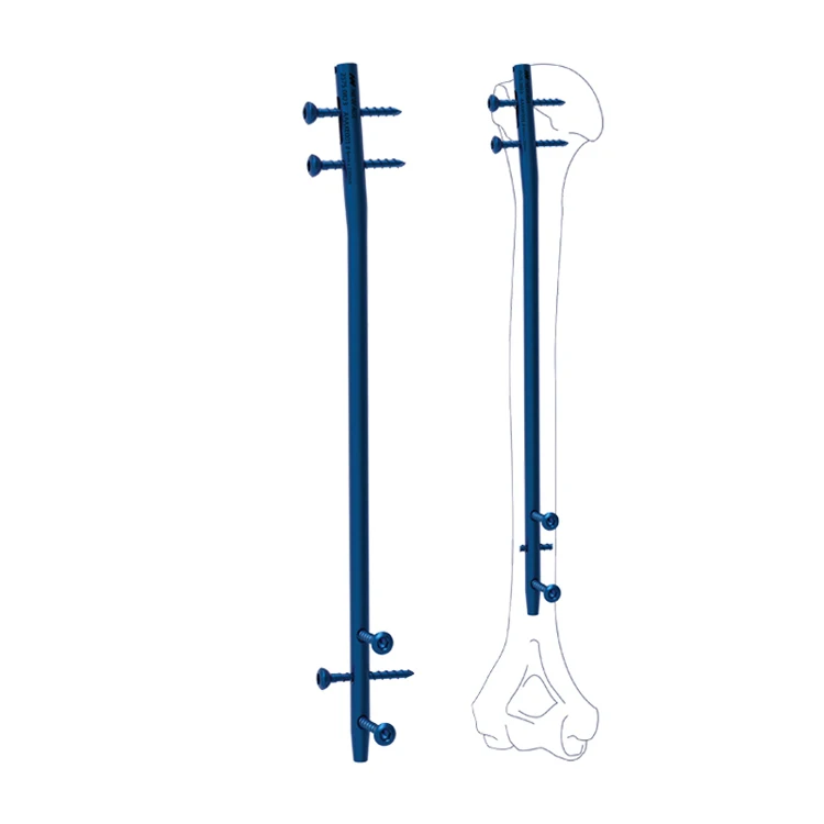 Ортопедический дизайн маникюрного дизайна, сцепляющийся титановый гвоздь с ручками, Сертификация CE ISO, диаметр 6 мм для здоровья и медицинской больницы