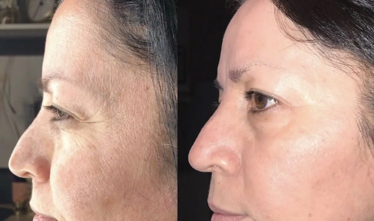 
Otesaly Skin Rejuvenation Device Anti Wrinkle Non Cross-linked HA 