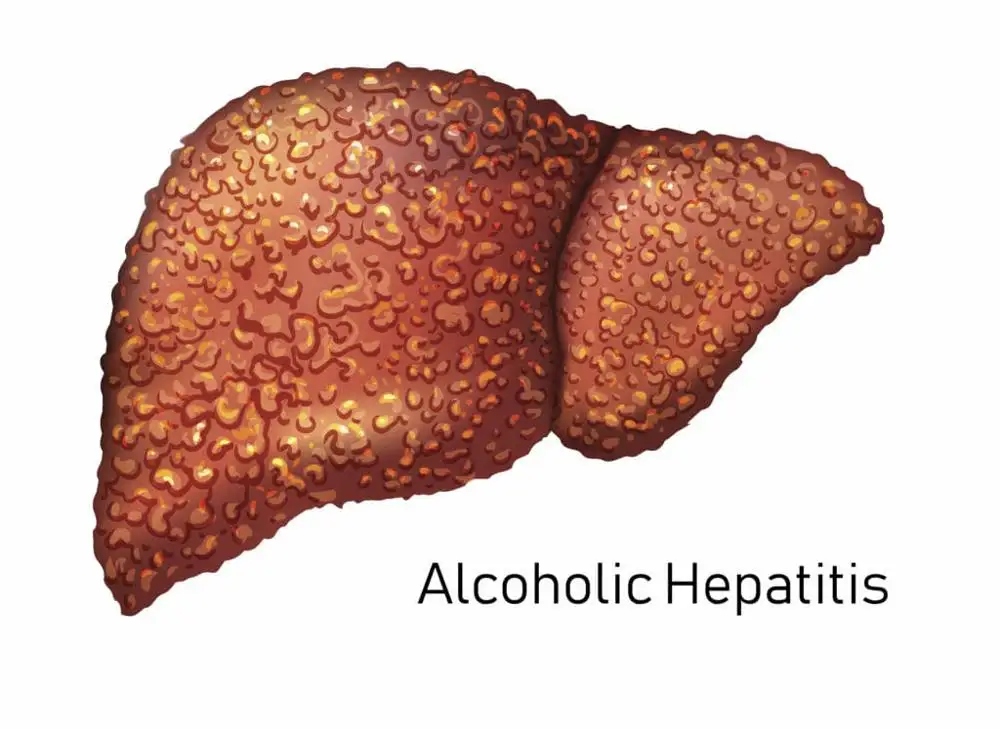 
Alcoholic Hepatitis - Organic Ayurvedic Herbal Medicine - Complete Assured Treatment - AVOID LIVER TRANSPLANTATION 