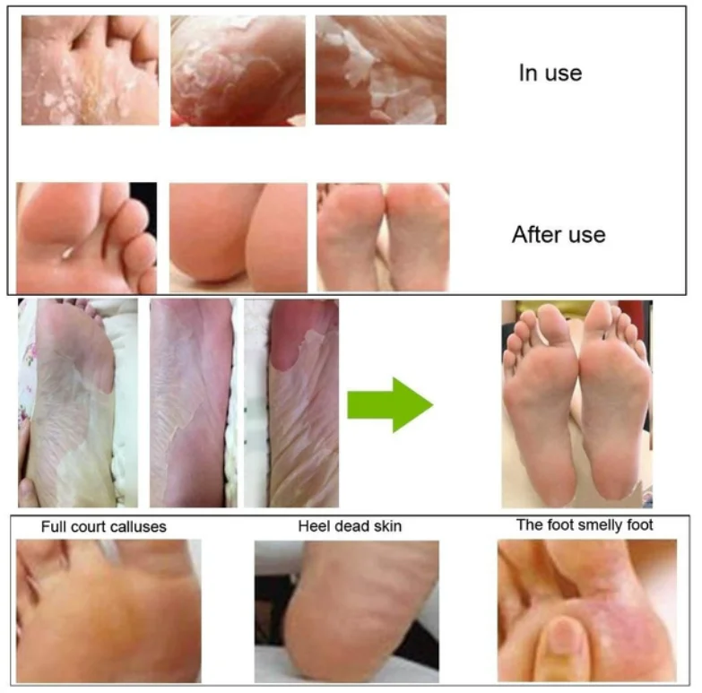 Korea OEM Hinoki Foot Peeling Mask foot peel spa socks exfoliating foot mask