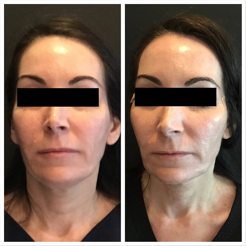 Beauty skin care absorbable sutures 25mm mono lift vline face nose blunt cannula pdo thread