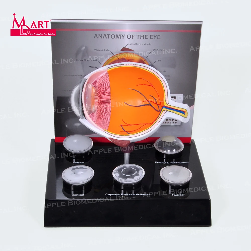 
Human eye model with replaceable disease cataract lens in medical science 
