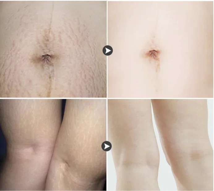Best Massage Cream for Stretch Marks Removal