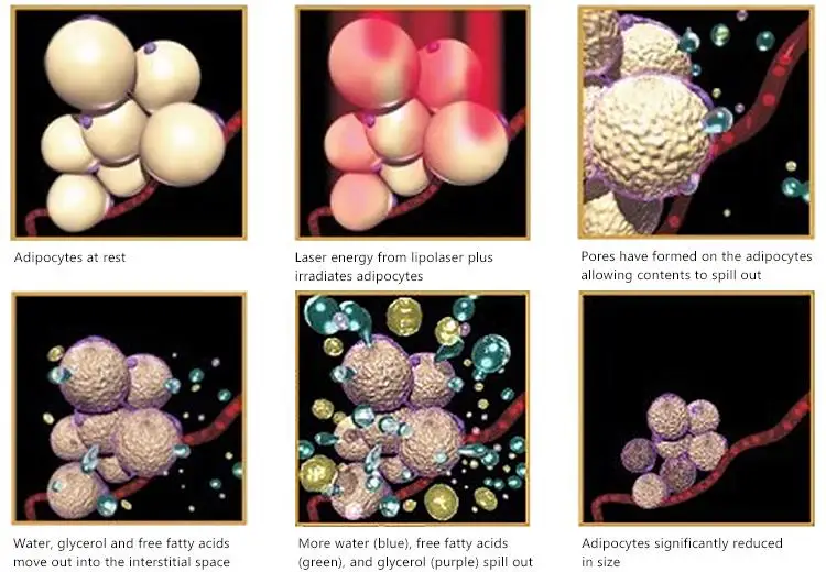 laser lipo machine.jpg