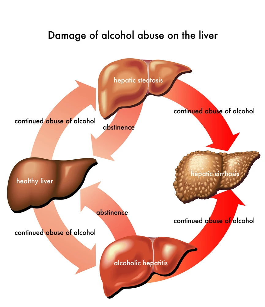 
Alcoholic Hepatitis - Organic Ayurvedic Herbal Medicine - Complete Assured Treatment - AVOID LIVER TRANSPLANTATION 