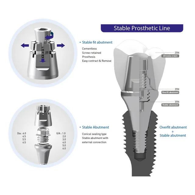 [ID стоматологический] корейский Недавно Рост популярная Стоматологическая аппаратура давец для абатмента стабильный стабильную посадку передачи справиться
