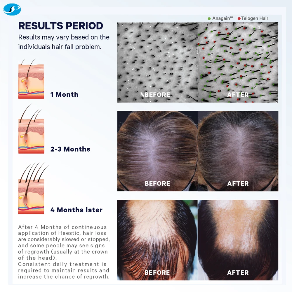 WholesaleHair Growth Programme proven by science Hair Growth Treatment Set 4pcs hair loss Perfect for Natural Hair Care