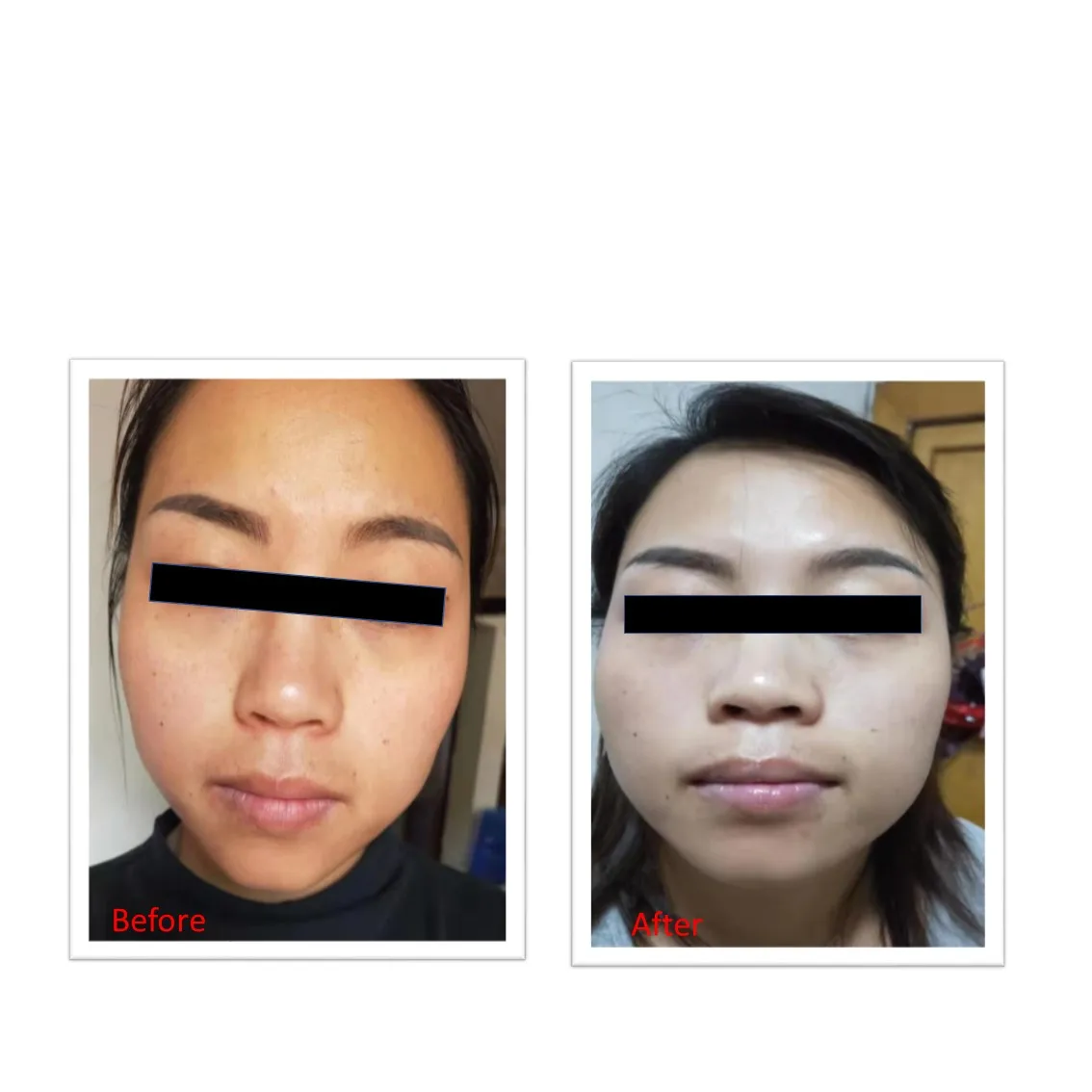 Cosmetic plant cell toner for hyaluronic acid toner