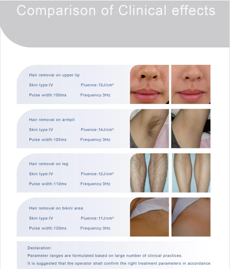 Super High qualiyu and good price 755 808 1064nm diodelaser hair removal portable beauty device