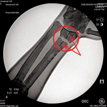 Sawbones 1530 Colles тренировочная техника снижения и литья