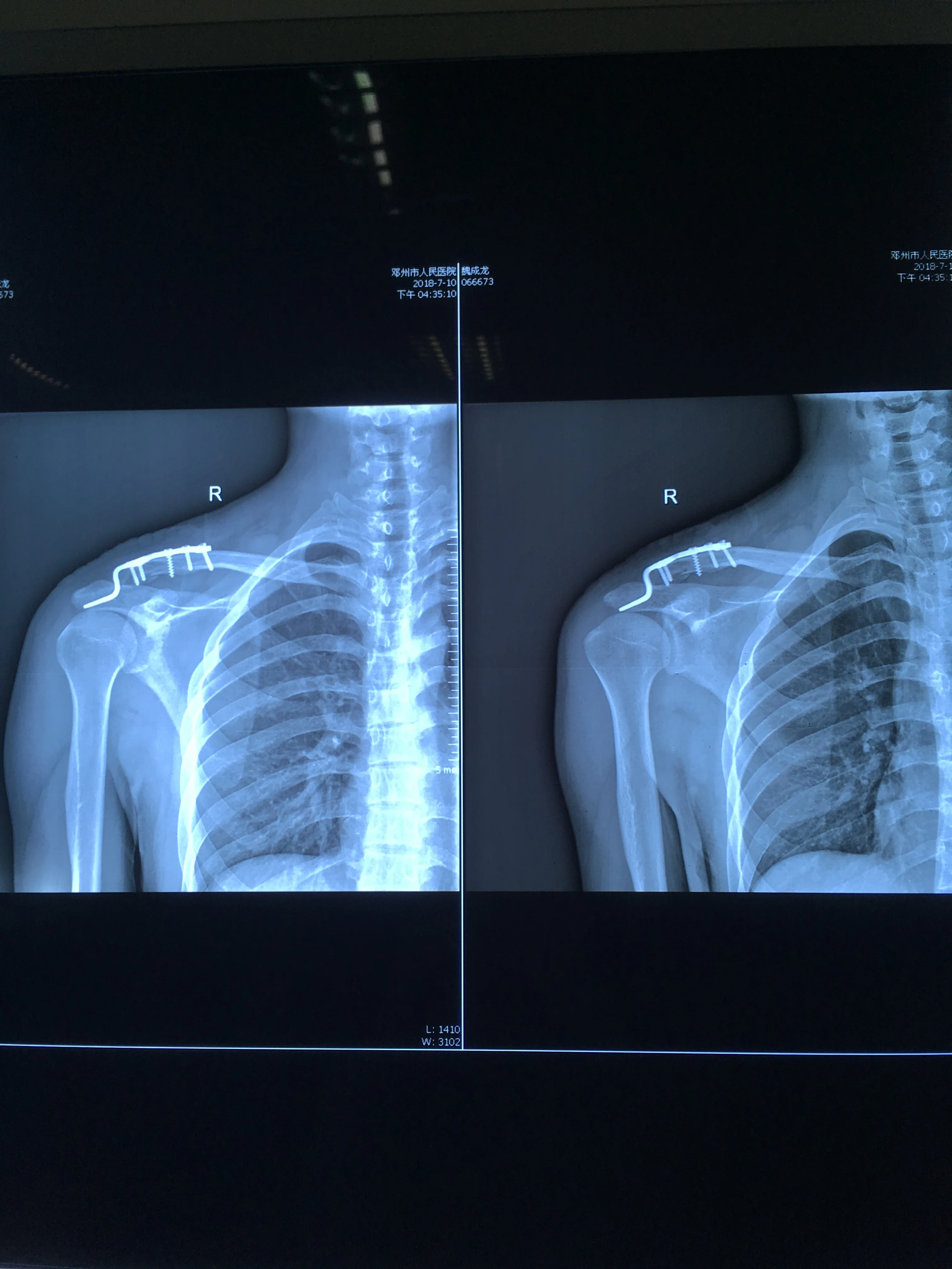 Синяя 8*10 дюймов 20*25 см сухая медицинская рентгеновская МРТ ct цифровая пленка для теплового принтера imager Agfa 5300/5302/5500/5503 Fuji 3500 2000