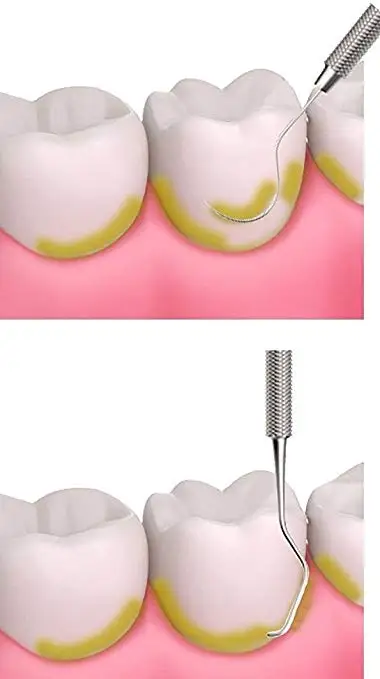 Набор для удаления зубного налета 2024